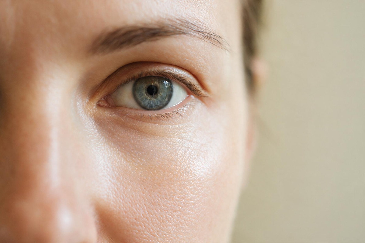 Nanofat and hyaluronic acid filler compared for the under-eye hollow