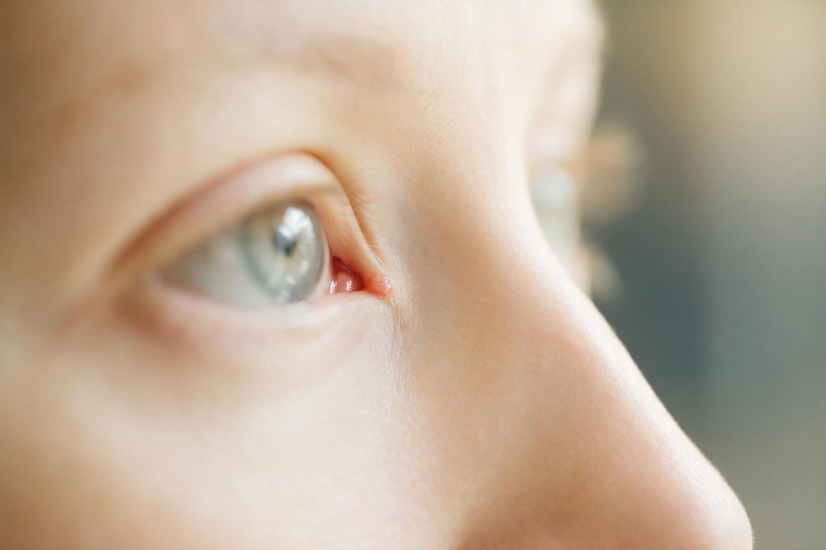 Lacrimal sac infection at the inner corner of the eye