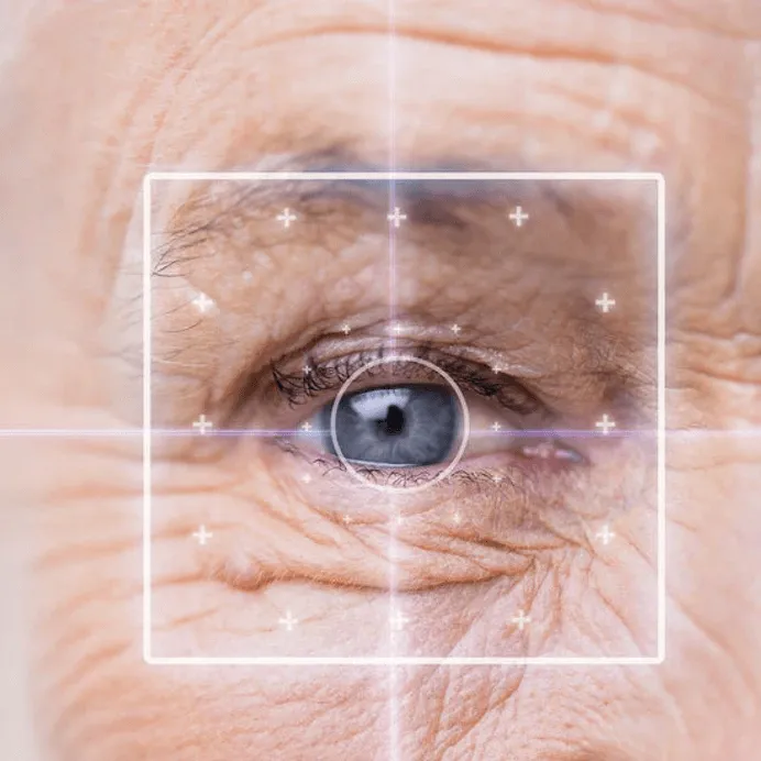 Cataract